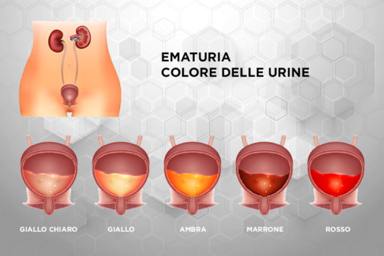 Patologie_Ematuria