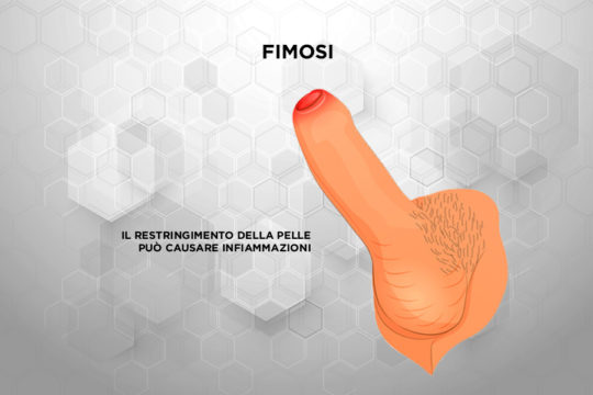 Patologie_Fimosi