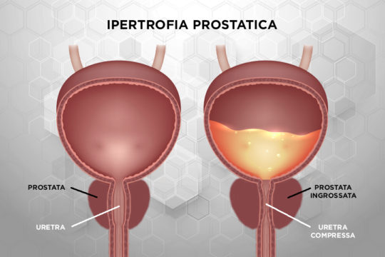 Patologie_Ipertrofia