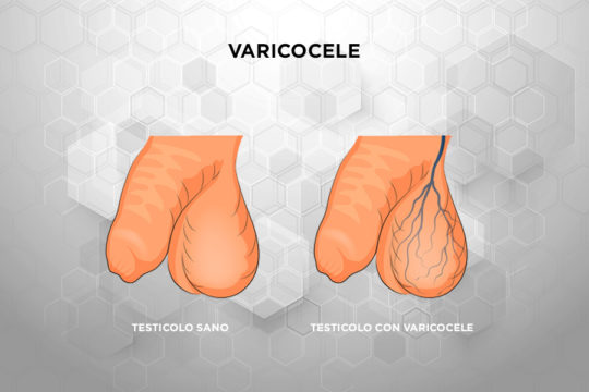 Patologie_Varicocele