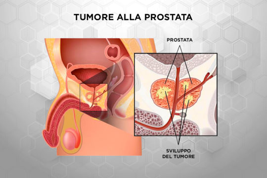 Patologie_Tumore_Prostata