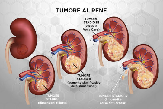 Patologie_Tumore_Rene