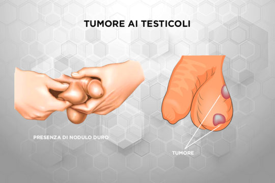 Patologie_Tumore_Testicoli