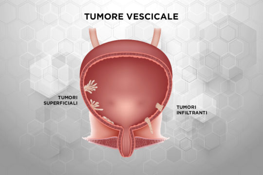 Patologie_Tumore_Vescica